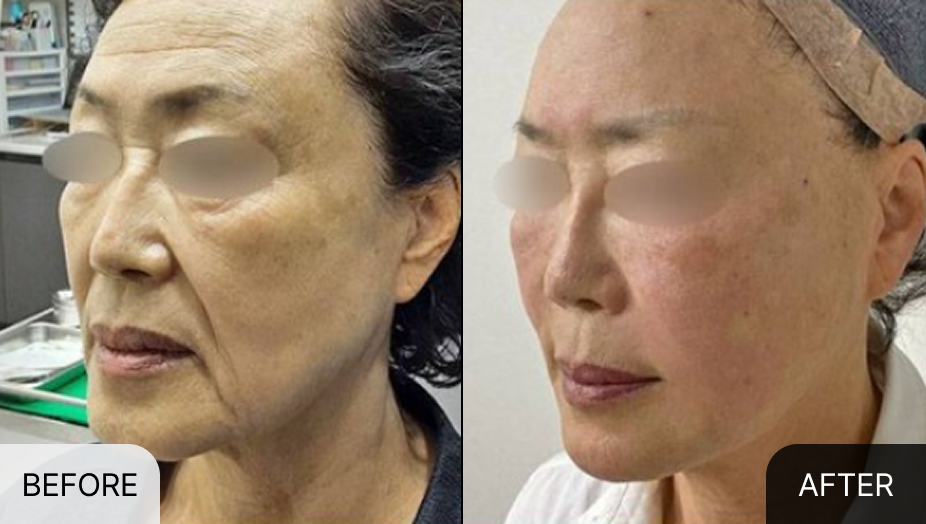 풀페이스 필러, 실리프팅 전후사진