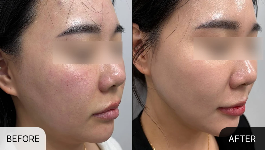바이리즌 물광주사 시술 전후 비교 사진 - 바로그의원